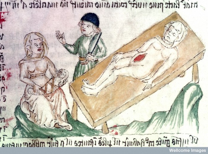 L0000846 Gynaecological texts, Caesarean section Credit: Wellcome Library, London. Wellcome Images images@wellcome.ac.uk http://wellcomeimages.org Gynaecological texts, including information about conception, pregnancy and childbirth - Woman who died in childbirth on operating table, with doctor holding knife after delivering baby by Caesarean section, a nurse holding swaddled child Ink and Watercolour Circa 1420-30 MS 49 Apocalypse, (The), [etc.]. Apocalypsis S. Johannis cum glossis et Vita S. Johannis; Ars Moriendi, etc.; Anatomical, medical, texts, theological moral and allegorical 'exempla' and extracts, a few in verse. Published:  -  Copyrighted work available under Creative Commons Attribution only licence CC BY 4.0 http://creativecommons.org/licenses/by/4.0/